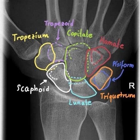 MSK Is Brilliant Radiology On Instagram Anatomy Of The Carpal Bones Of The Wrist Scaphoid