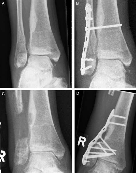 Coverage Of Exposed Bone Of The Lateral Malleolus With A Proximally