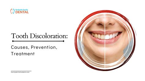 Tooth Discoloration Causes Prevention Treatment