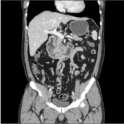 Abdominal Ct Computed Tomography Shows An Abnormal Finding Mimicking