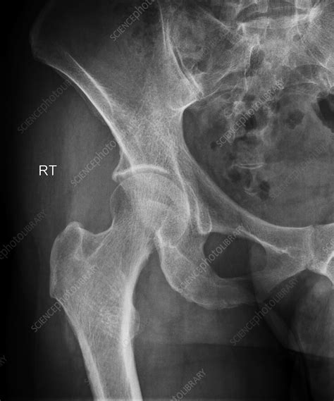Normal Hip X Ray Stock Image C0393297 Science Photo Library