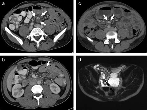 A Axial Intravenous Contrast Enhanced Computed Tomography Ct Image