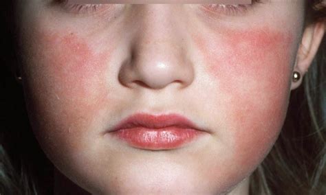 Fifth Disease In Children And Adults Health And Beauty