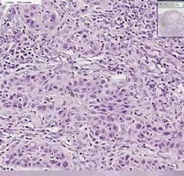 Squamous cell carcinoma is a common skin cancer that usually looks like a red bump or a scaly sore. Histopathology Skin--Squamous cell carcinoma - YouTube