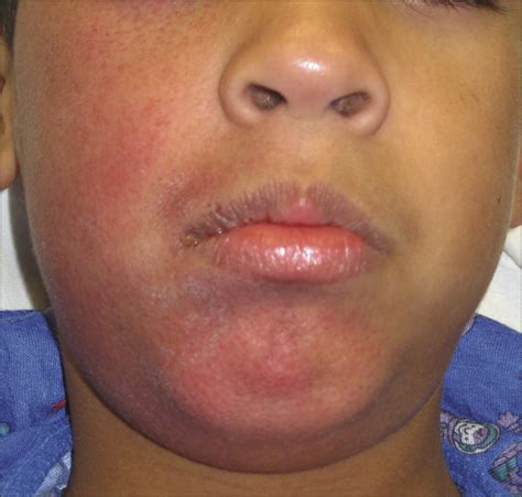 Picture Of The Month—quiz Case Dermatology Jama Pediatrics Jama