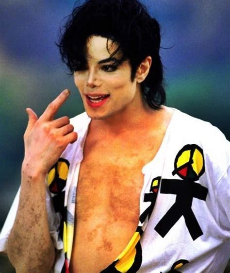 You Can See The Patches Of Vitiligo On His Skin Michael Jackson In