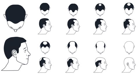 Update More Than 74 Types Of Hair Loss Male Super Hot In Eteachers