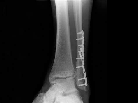 Ankle Plating System Acumed