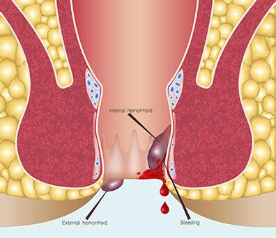Can Anal Fissure Cause Severe Bleeding Telegraph