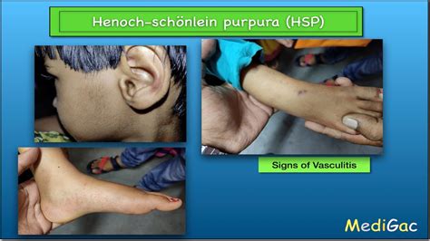 Henoch Schonlein Purpurahsp Clinical Features Pathophysiology