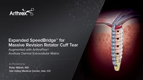 Arthrex Speedbridge™ Rotator Cuff Repair