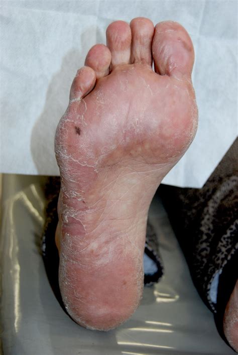 Soles Of Feet Also Showed More Intense Spots And Got Erythematous And