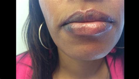 Clinical Challenge Pruritic Hyperpigmentation Of The Lips Mpr