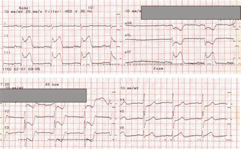 Acute St Elevation Myocardial Infarction Of Inferoposterior Wall