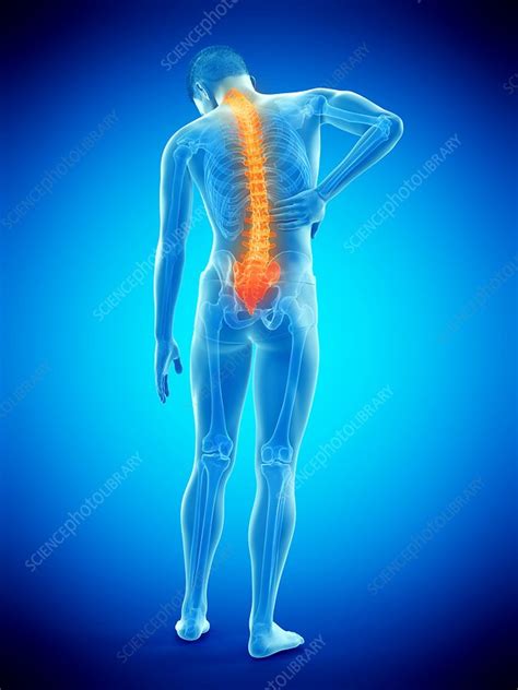 Back Pain Conceptual Illustration Stock Image F0257635 Science