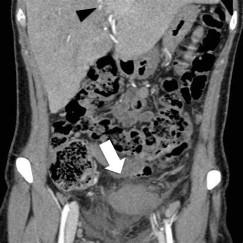 Axial Ct Scan Shows A Further Contrast Enhancing Lesion In The Liver In