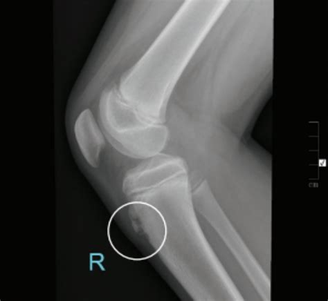 Osgood Schlatter Disease X Ray