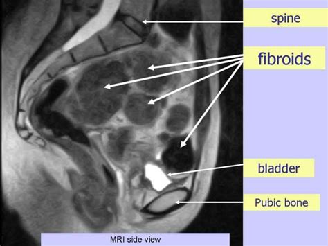Standard treatments uterine fibroid embolization ufe clinical outcomes. Xray of Fibroids in the body | Uterine fibroids, Fibroids ...