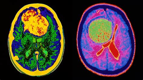 Operable Brain Tumor Life Expectancy Brain Tumor Cancer