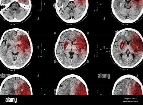 Ischemic Stroke CT Of Brain Show Cerebral Infarction At Left Frontal Temporal Parietal