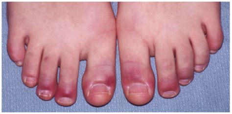 Common Health Problems Associated With Your Feet Dr Thind