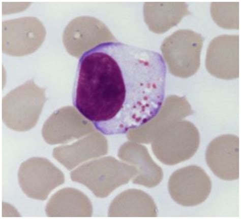 Typical Large Granular Lymphocyte Morphology As Detected In A Clpd Nk