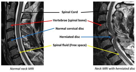 Anterior Cervical Discectomy And Fusion Acdf