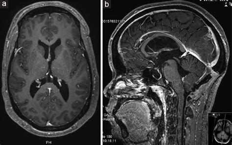 Fourth Ventricle Neurocysticercosis A Case Report Surgical Neurology