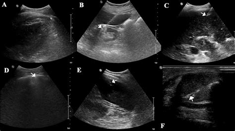 Diagram Prostate Ultrasound Biopsy Diagram Mydiagramonline