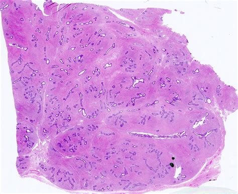 Pathology Outlines Fibroadenoma