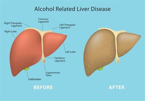 Alcohol Related Liver Disease And Its Symptoms And Treatment Earths