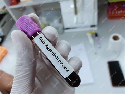 Premium Photo Scientist Holds Blood Sample For Cold Agglutinin