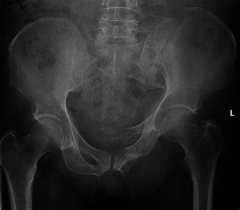 Malgaigne fracture | Image | Radiopaedia.org
