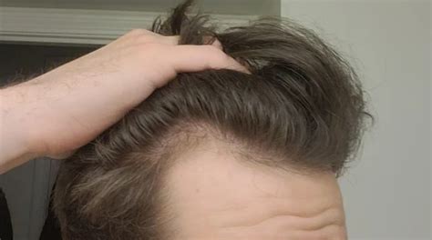 Balding At 20 Signs Causes And How To Cope