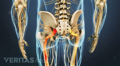 Sciatica What You Need To Know About Sciatica