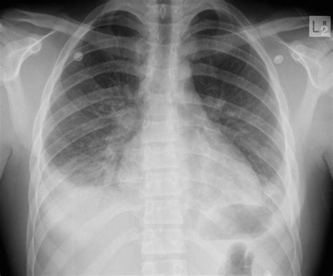 Pneumonia Case 001 • Litfl • Ultrasound Library Clinical Case