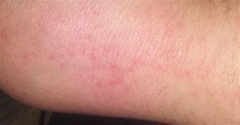 I Have This Rash On My Right Hand What Could It Be Girlsaskguys