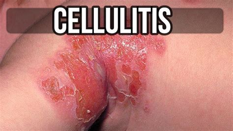Cellulitis Symptoms Causes Treatments More Youtube