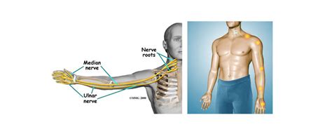 Neck And Arm Pain Treatment California Chiropractic Dubai