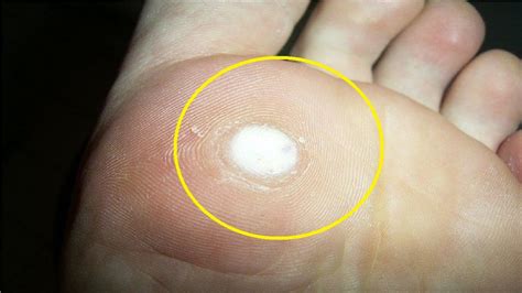 How To Get Rid Of Plantar Warts On Feet Home Remedies Fast Youtube