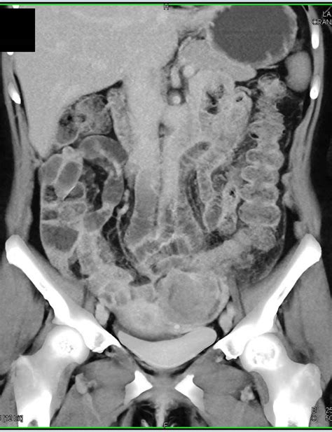 Ovarian Cancer And Carcinomatosis Obgyn Case Studies Ctisus Ct