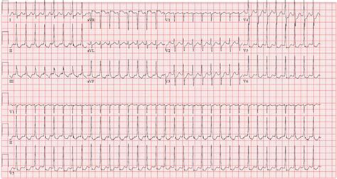 Mksap Quiz Abrupt Onset Palpitations Acp Internist