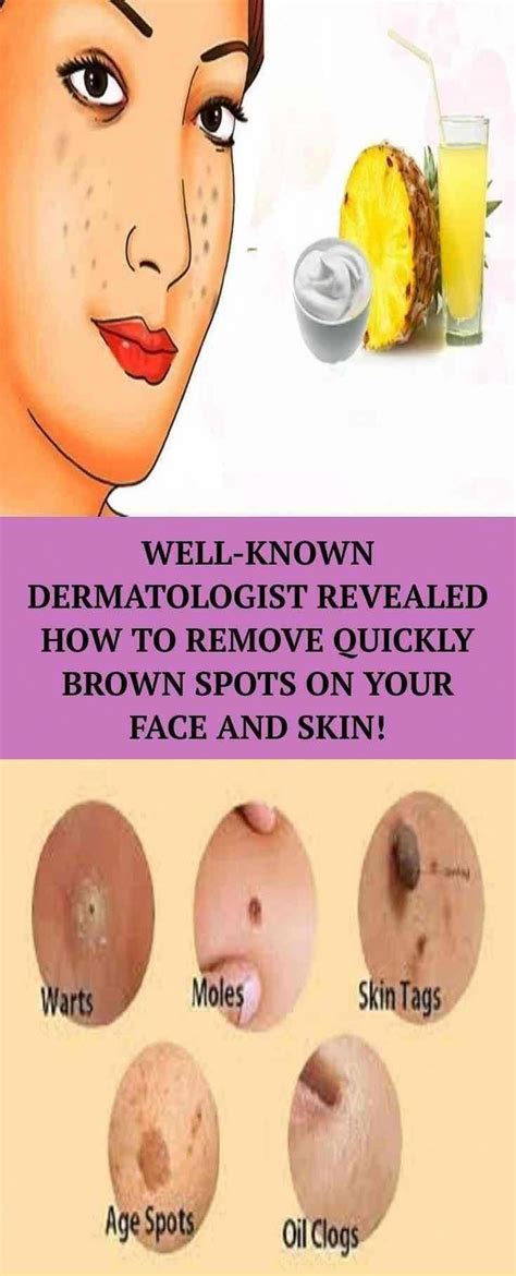 How To Get Rid Of Brown Spots On Confront Brownspotsremoval