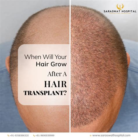 Aggregate Days After Hair Transplant In Eteachers