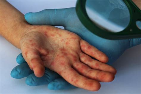 Viral Rash On Child Types Causes Treatment And Prevention