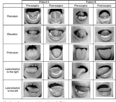 Figure From Lingual Frenulum Changes After Frenectomy Semantic Scholar