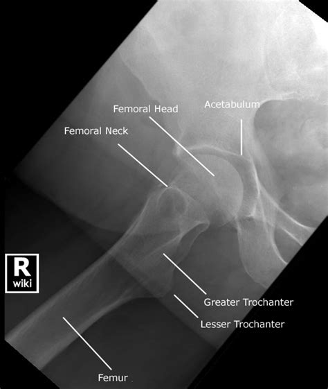 Hip Radiographic Anatomy Wikiradiography