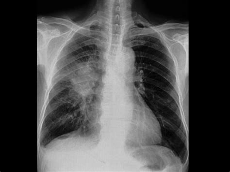 Idiopathic Pulmonary Fibrosis Prognosis Predicted By Ct Parameters