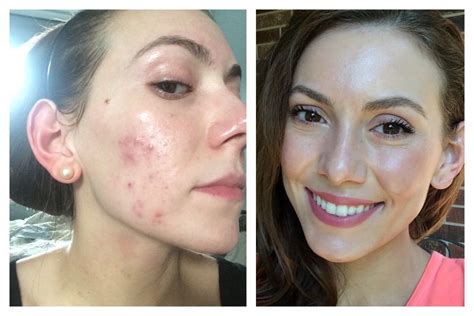 10 Ways To Get Rid Of Hormonal Acne Fast And Naturally Hormonal Acne