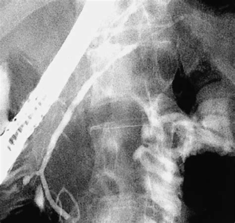 Endoscopic Retrograde Pancreatogram That Was Done 3 Months After